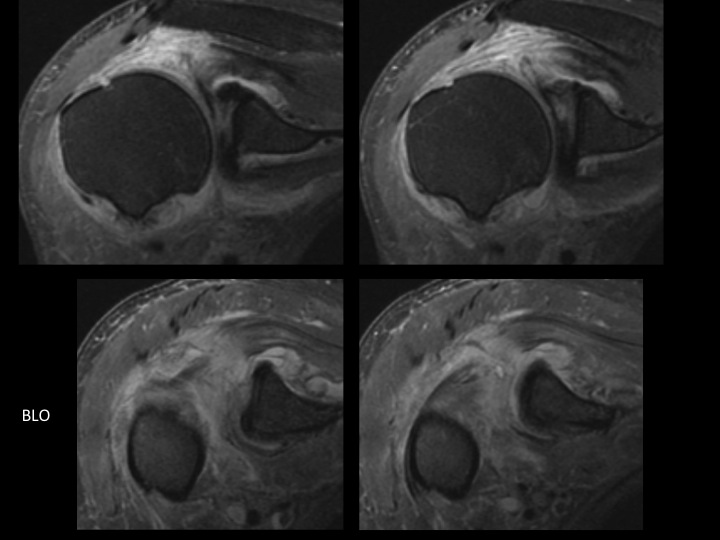 Figure 3 for case tendon of long head of biceps brachii ( RID1944 )